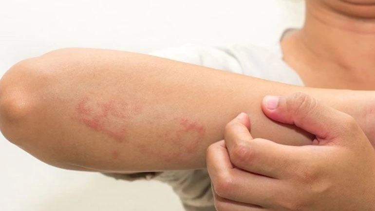 Ένας στους δέκα ανθρώπους θα εκδηλώσει έκζεμα κάποια στιγμή στη ζωή του